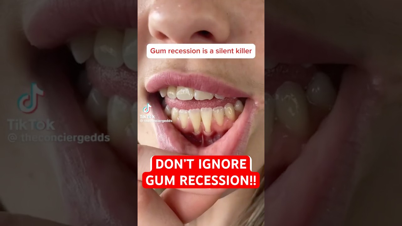 Gum Recession Doesn’t Go Away- it gets ANGRIER! #gumgraft #gumrecession #washingtondc #periodontist