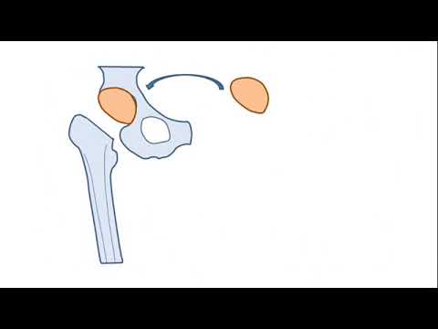 Hip and Knee Academy – HTP Einbau Schematisch