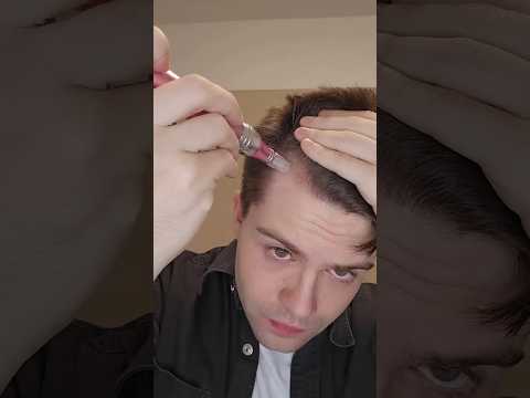 Beating hair loss with a microneedle derma pen