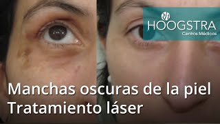 Manchas oscuras de la piel   Tratamiento láser 20093