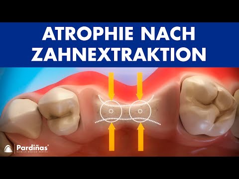 Atrophie nach Zahnextraktion ©
