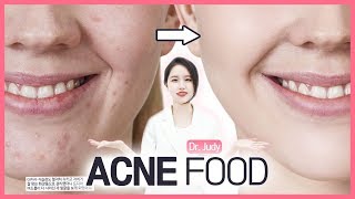 성인 여드름 지성 피부타입 관리 💥유분기 피지 관리💥피부에 좋은 음식  Inner Beauty 식단ㅣ 피부좋아지는법 ㅣ 닥터주디 Dr.Judyㅣ피부과전문의 주홍진