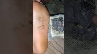 Download lagu PART 2 REMOVING TOXINS FROM THE BODY mp3 Download lagu PART 2 REMOVING TOXINS FROM THE BODY mp3