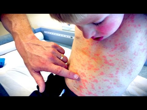 IMPRESSIVE FULL BODY RASH! | Live Diagnosis With Dr. Paul Video