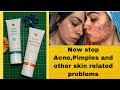Now Stops Acne Pimples Scars And Other Skin Problems Forever Aloe Propolis Cream Aloe Gelly