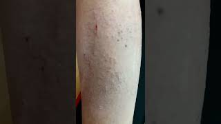 Mind Control Weapon to cause heat rash to itch