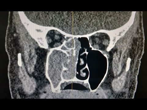 tratamentul infecțios al parazitului pe plan intern