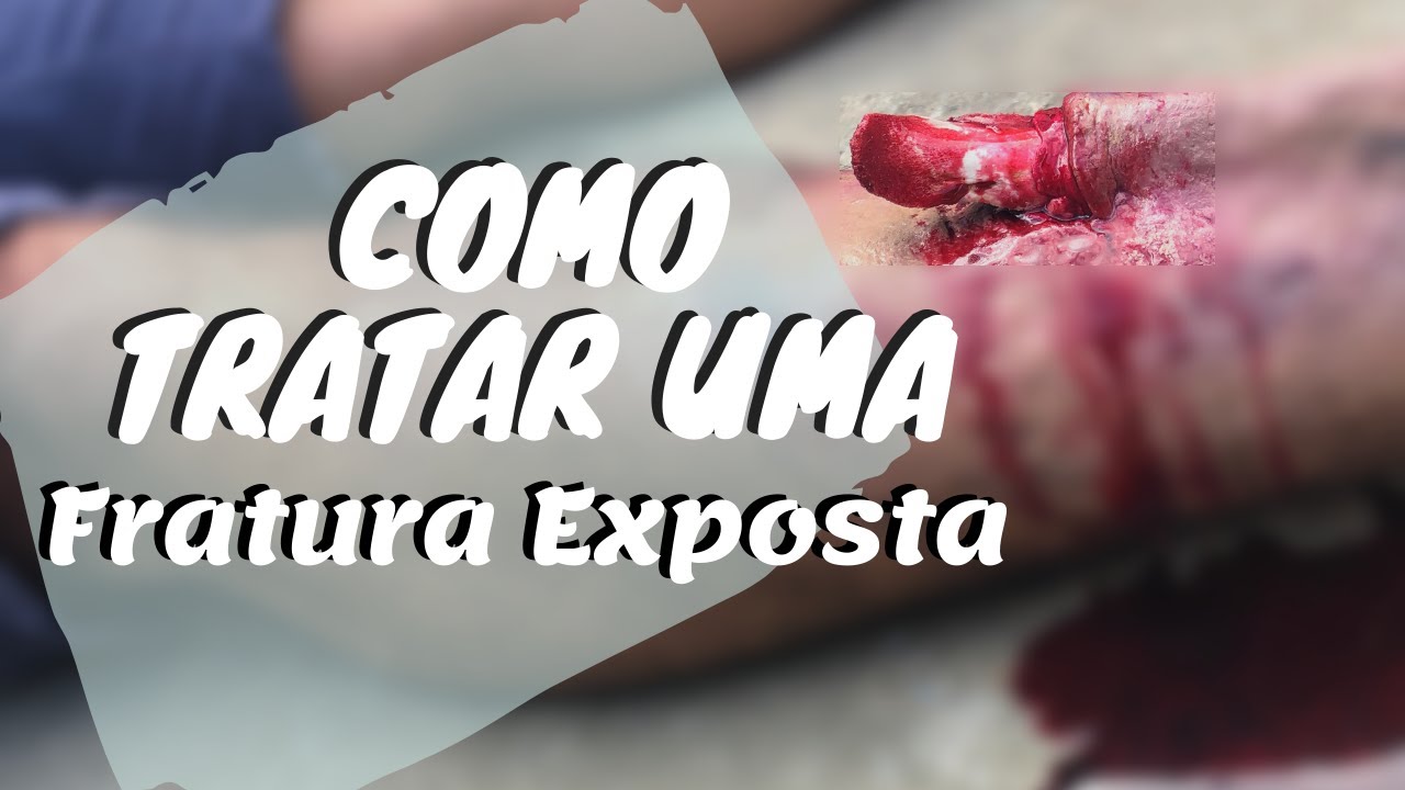 Fratura Exposta - Saiba como tratar um fratura exposta