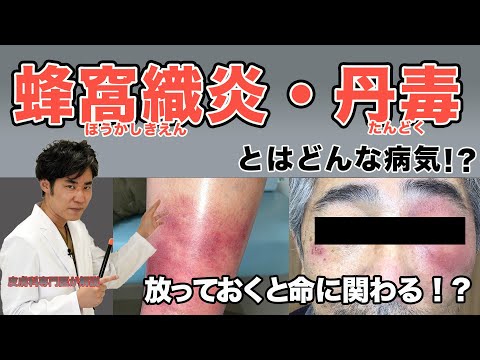 丹毒丹毒について詳しく解説