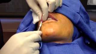 preview picture of video 'SurgiSil PermaLip - Permanent Lip Augmentation in Chevy Chase, MD - Dr. Kulak'