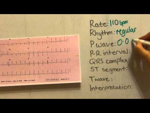 ECG Interpretation