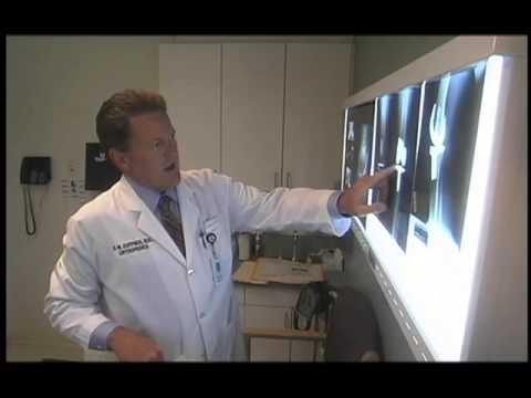 Causes of Pleurisy Video