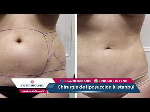download lagu mp3 mp4 Liposuccion Turquie, download lagu Liposuccion Turquie gratis, unduh video klip Liposuccion Turquie