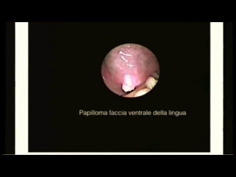 Come aiutare te stesso con lussazione articolare Esacerbazione della malattia cronica degenerativa del disco lombare, della