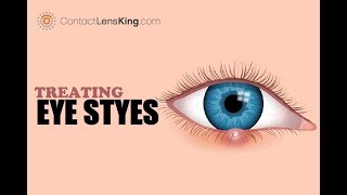 How to Treat Eye Styes