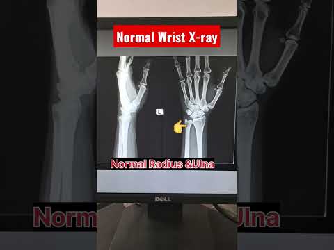 Fracture Wrist X-ray | Fracture Distal Radius Ulna #shorts #radiography #fracture #radiology #xray