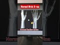 Fracture Wrist X Ray Fracture Distal Radius Ulna Shorts Radiography Fracture Radiology Xray