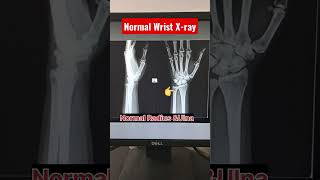 Download lagu Fracture Wrist X-ray | Fracture Distal Radius Ulna #shorts #radiography #fracture #radiology #xray mp3 Download lagu Fracture Wrist X-ray | Fracture Distal Radius Ulna #shorts #radiography #fracture #radiology #xray mp3