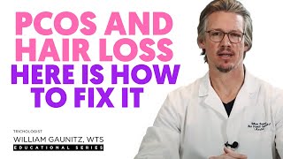PCOS Hair Loss: Why It Happens & What To Do About It (PCOS Hair Loss Treatment)