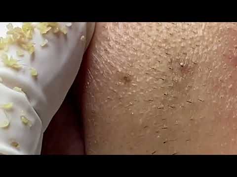 Acne treatment for Spa Linh Mun 2024 #97