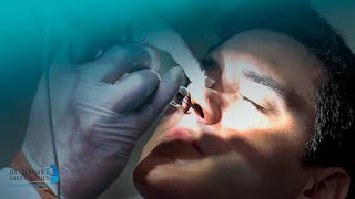 Reducción de Cornetes