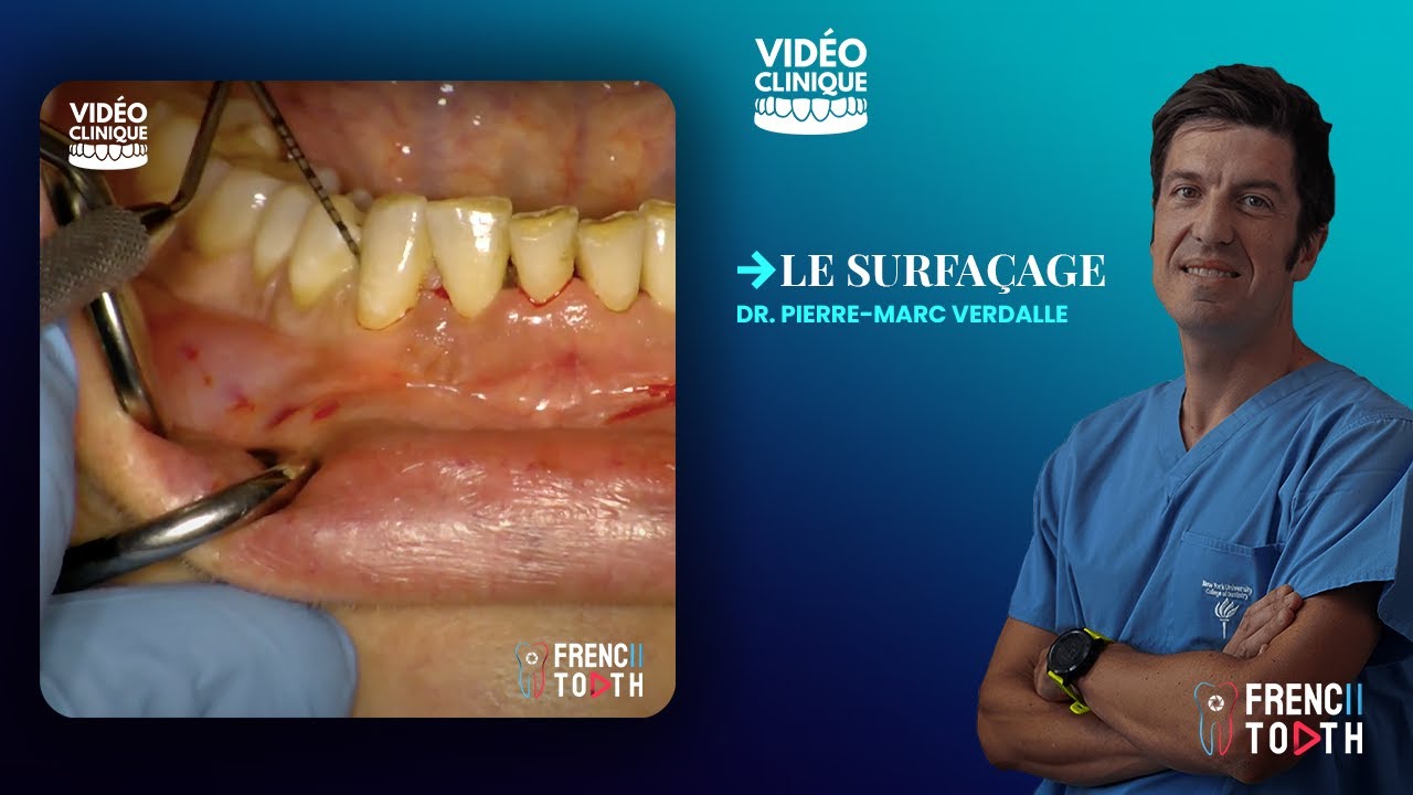 Le surfaçage protocole complet