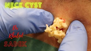 Never Ending Cyst. Dr Khaled Sadek. LipomaCyst.com