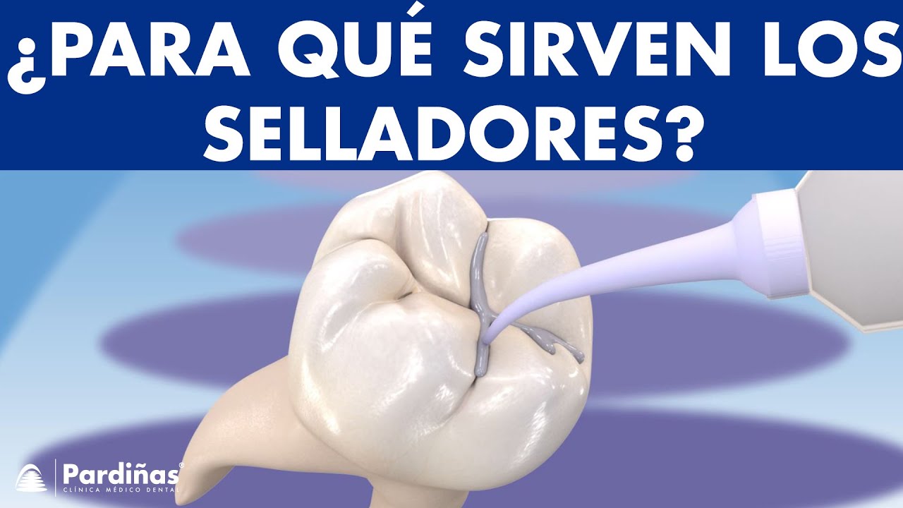 Watch Selladores dentales - Sellado de fosas y fisuras para prevenir caries © Now Selladores dentales - Sellado de fosas y fisuras para prevenir caries ©