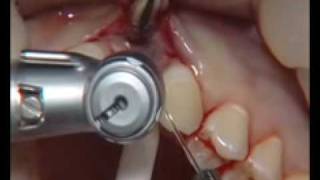 preview picture of video 'Dental Implant & Crown Procedure - As natural as your Teeth,Ludhiana,Punjab,India,jalandhar,Amritsar'