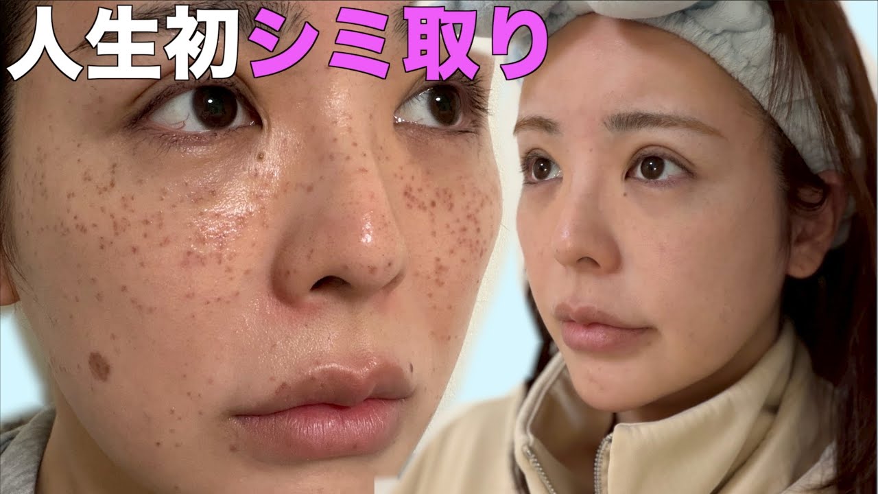 【人生初】シミ取りをしてきた！術後直後〜完成までを全部公開する！！！