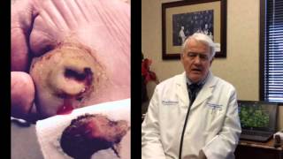 MRSA Testimonial on H2 Beverages