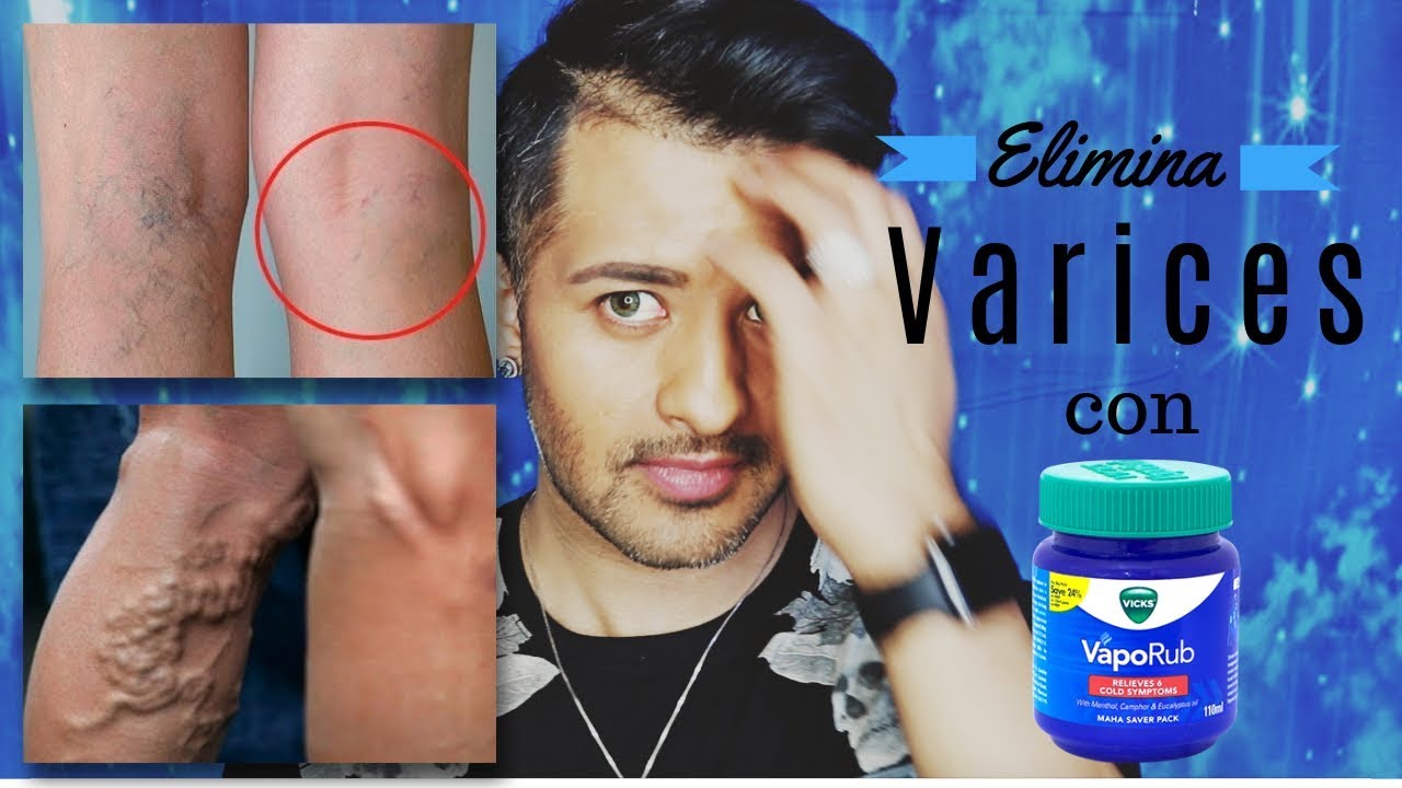 Watch ELIMINA VARICES CON POMADA DE VICKSVAPORUB Now ELIMINA VARICES CON POMADA DE VICKSVAPORUB