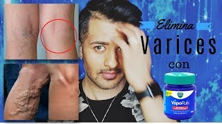 ELIMINA VARICES CON POMADA DE VICKSVAPORUB