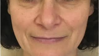 Facelift Contouring pre e post (Lifting Prima e Dopo)- Dott. Antonio Distefano