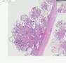 Histopathology Ovary--Serous cystadenoma