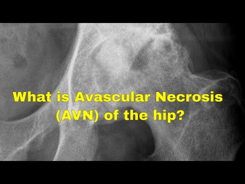 What causes avascular necrosis of the hip (AVN)?