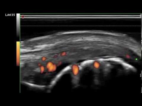 Segni di un parassita di un pinworm Vermi e microbi di video