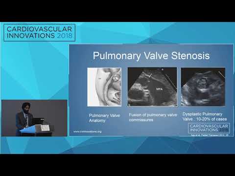 CVI2018 Session: Pulmonary Valve Stenosis - Updesh Singh Bedi MD