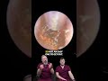 Watch This Ear Wax Removal
