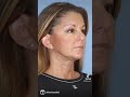 Amazing before and after from #necklift & #facelift by Dr. Kevin Sadati #plasticsurgery