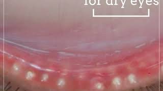 Download lagu iLux is here for dry eyes mp3