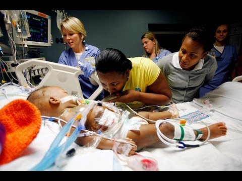 Conjoined Twins: Surgery