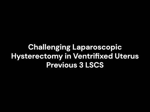 Challenging Laparoscopic Hysterectomy in a Ventrifixed Uterus