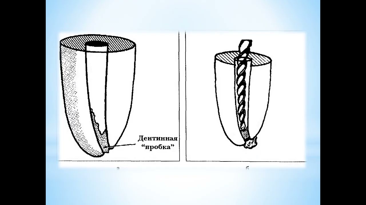 Ошибки и осложнения при эндодонтическом лечении