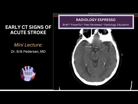 EARLY CT SIGNS OF ACUTE STROKE: Mini Lecture, Dr. Erik Pedersen, MD
