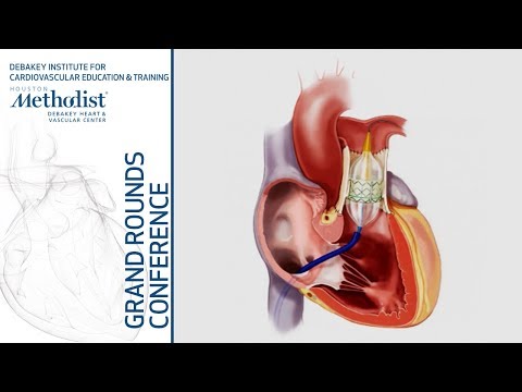 Update on Trans-catheter Interventions in Congenital Heart Disease (J. Aboulhosn, MD) Feb 21, 2019
