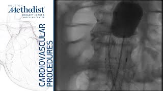 Download Lagu Endovascular Aortic Septotomy (Jean Bismuth, MD, Manuel Rojo, MD, M. Mujeeb Zubair, MD) Thumbnail