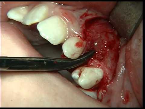 Removal of Odontoma