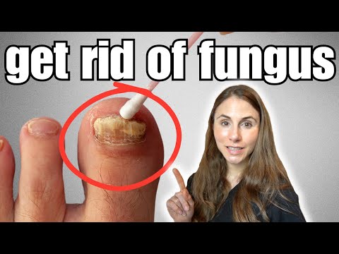 Get Rid Of Toenail Fungus With These 4 Easy Home Remedies