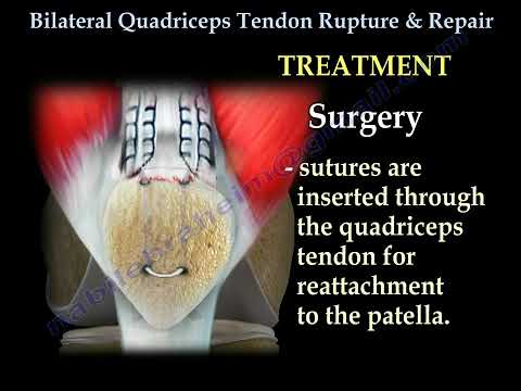 Rotura y reparación bilateral del tendón cuadricipital